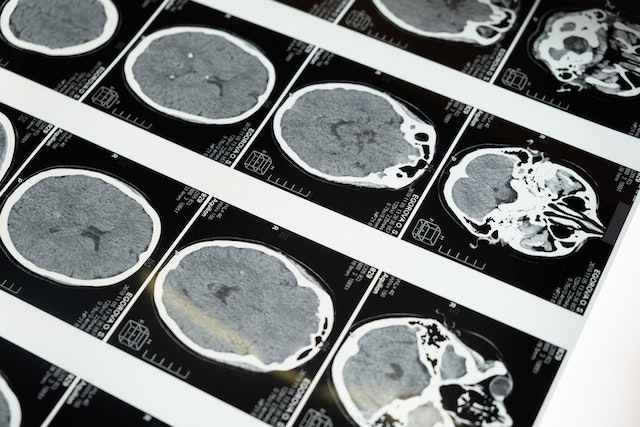 scans of brain injuries